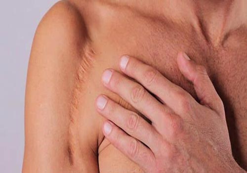 بوتاکس خط بخیه
