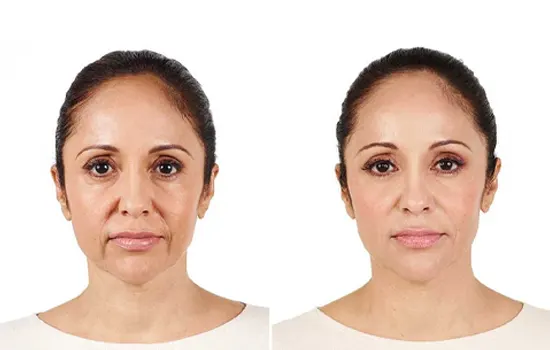 قبل و بعد تزریق خط خنده