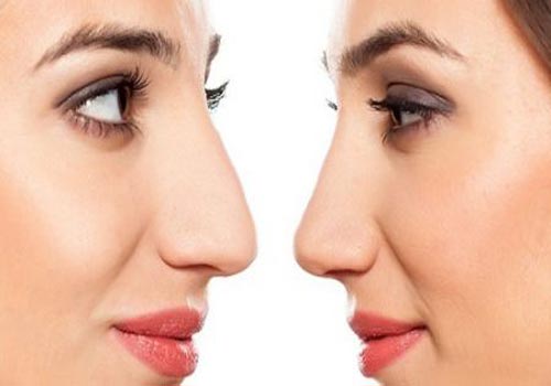فرم دهی بینی
